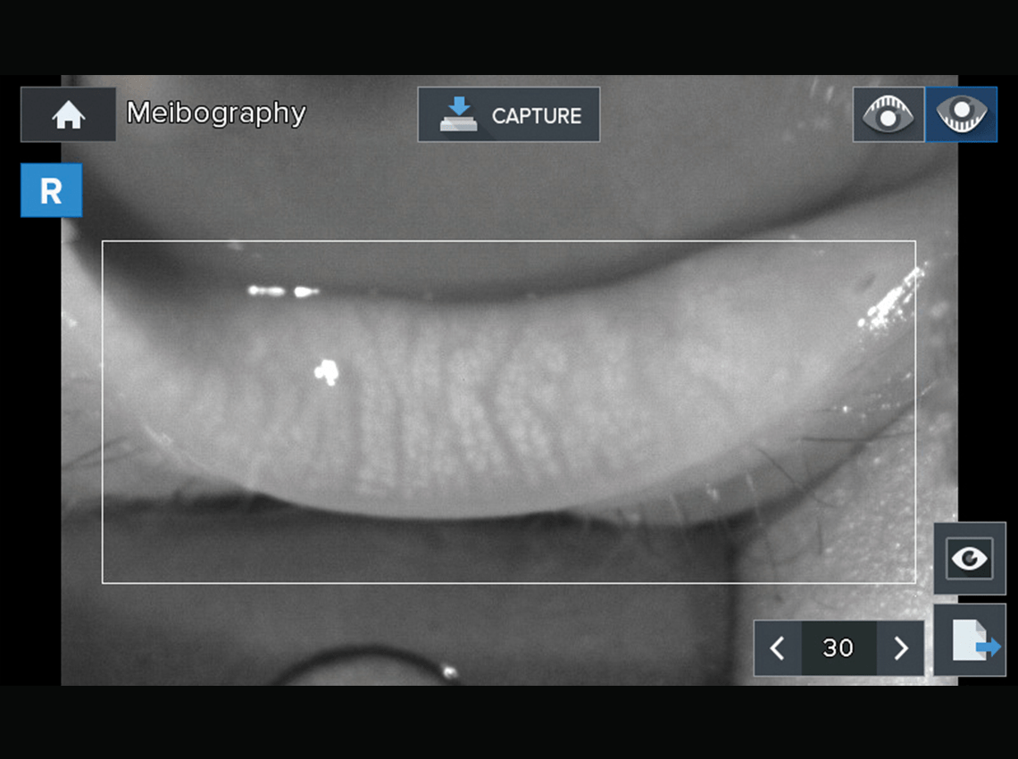 HRK-9000A infrared meibography showing meibomian gland structure
