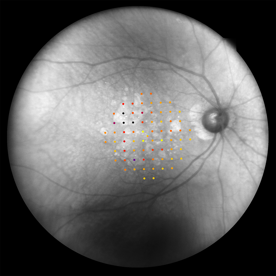 iCare MAIA infrared microperimetry grid for sub-surface detail