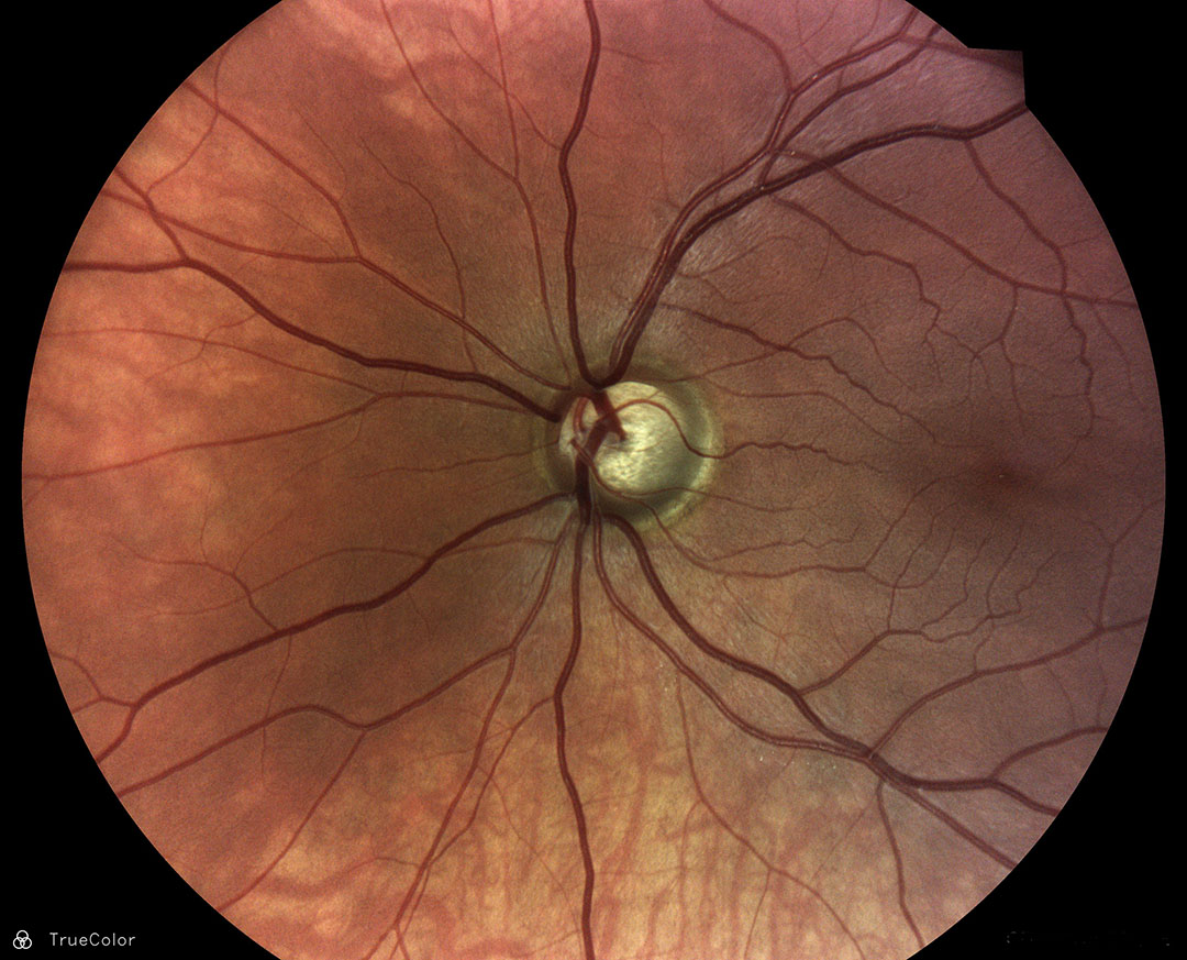 TrueColor fundus image showing glaucoma