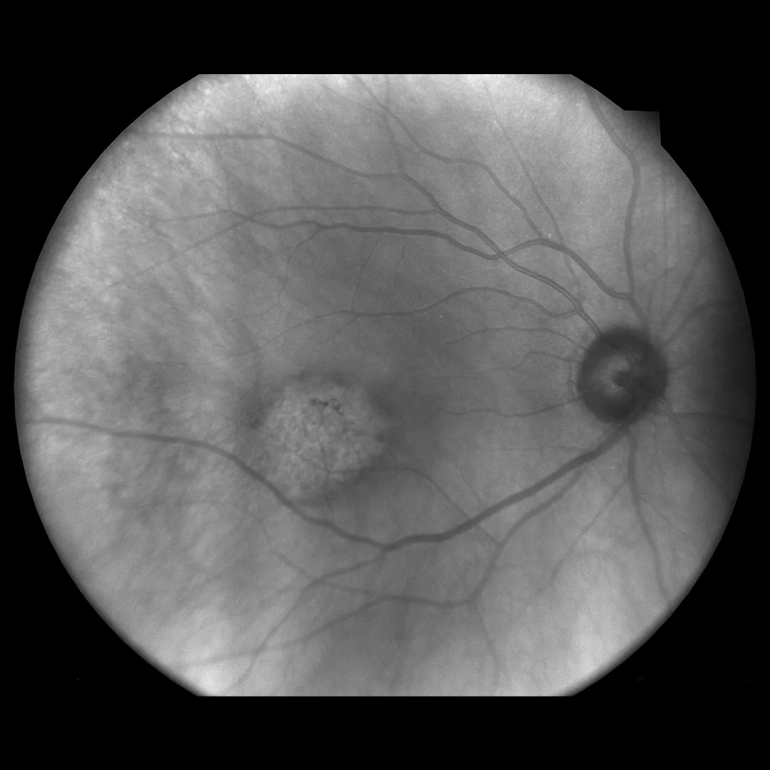 Infrared imaging modality for choroid