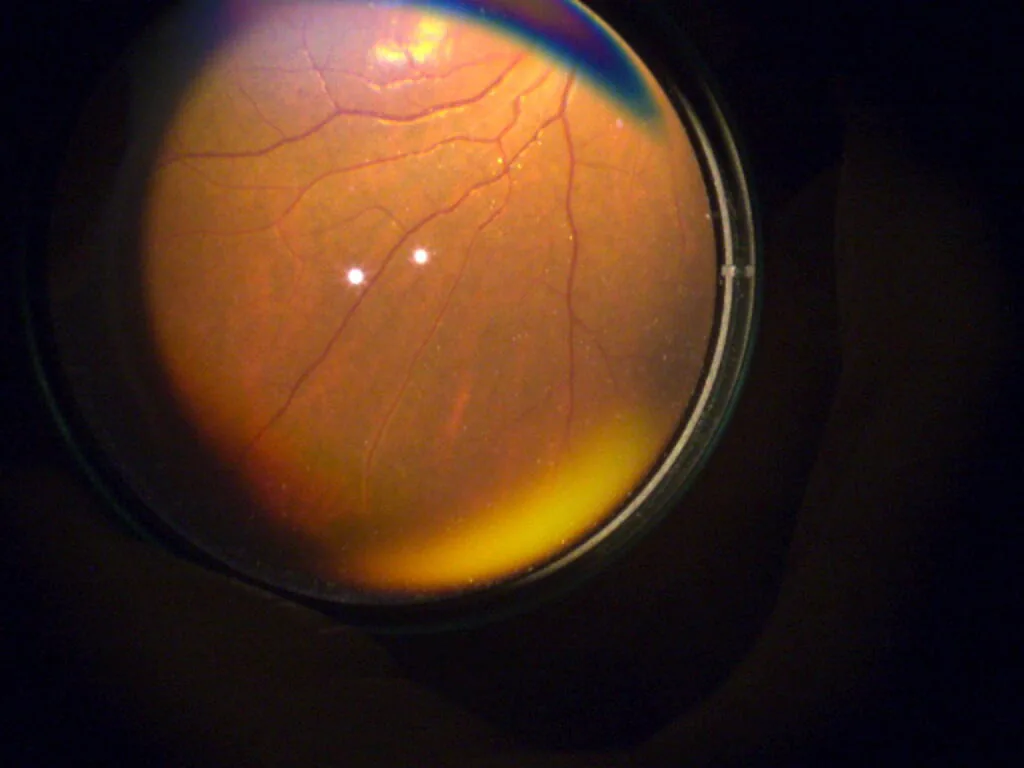 Retinal fundus image captured with the Keeler Vantage Plus Digital BIO